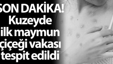 ozgur_gazete_kibris_saglik_bakanligli_maymun_cicegi_vakasi_tespit_edildi