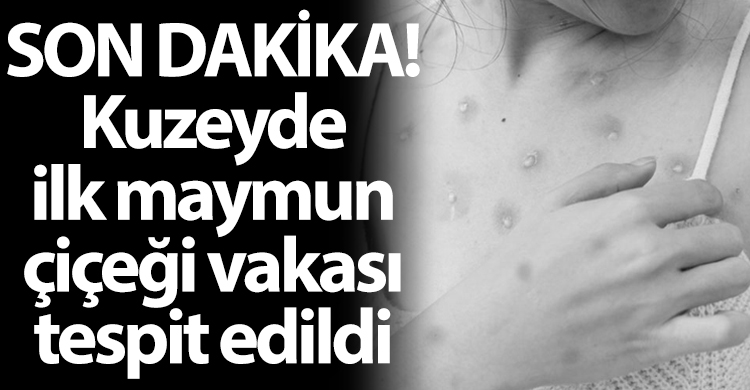 ozgur_gazete_kibris_saglik_bakanligli_maymun_cicegi_vakasi_tespit_edildi